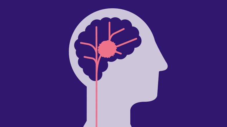 Infographic haemorrhagic stroke