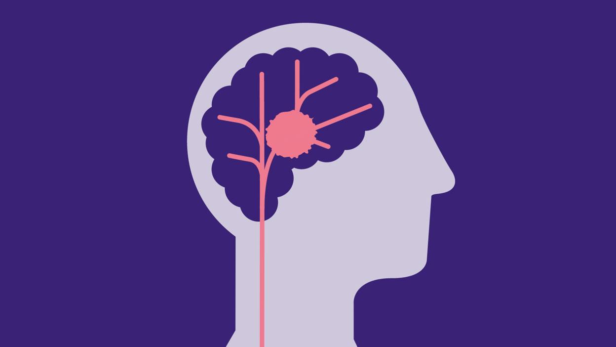 Illustration showing harmorrhagic stroke 