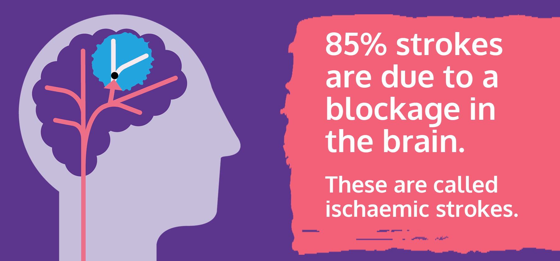 Graphic representation of ischaemic stroke by the Stroke Association