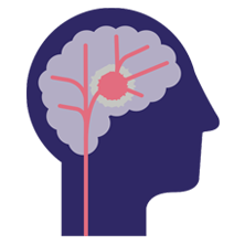 An icon of stroke in brain